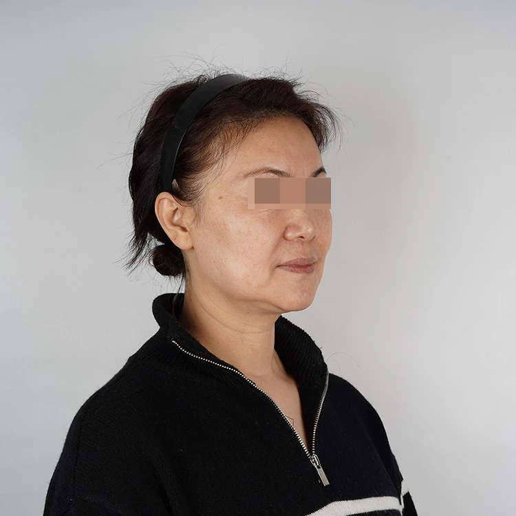 Nasolabial fold filler injection