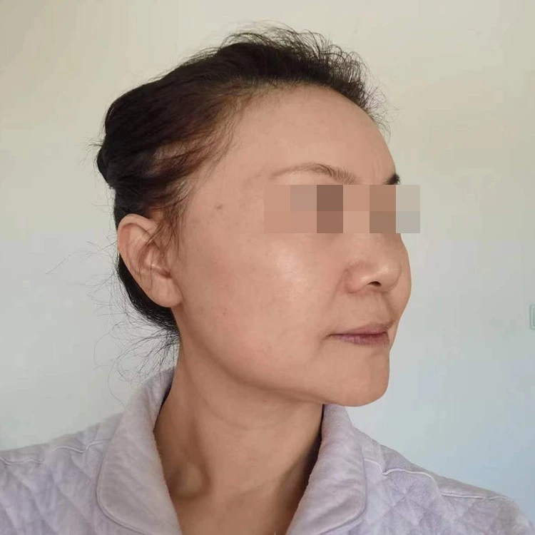 Nasolabial fold filler price