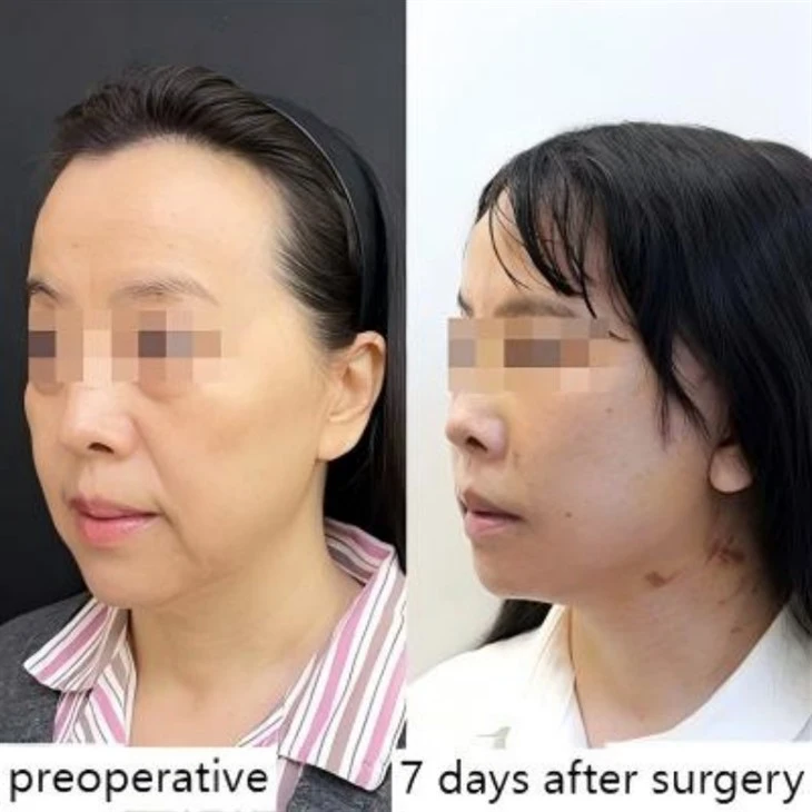 Facial Sagging Improvement