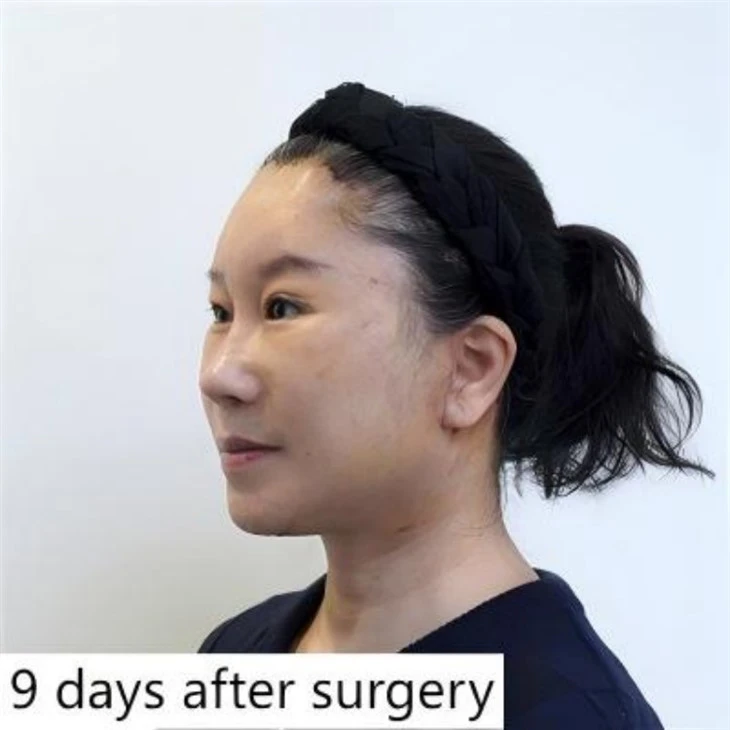 Lower Face Lift Prices