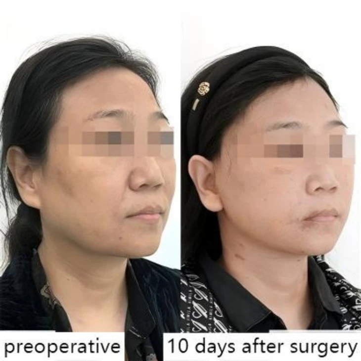 Nasolabial fold improvement results