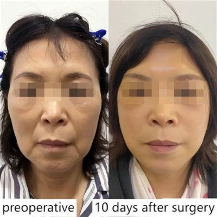 Improvement of sagging chin