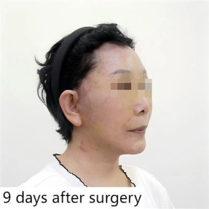 Recovery of drooping mouth corners