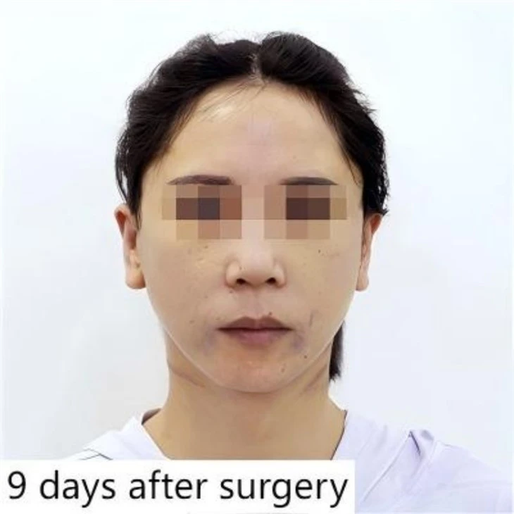 Lower Face Lift Surgery