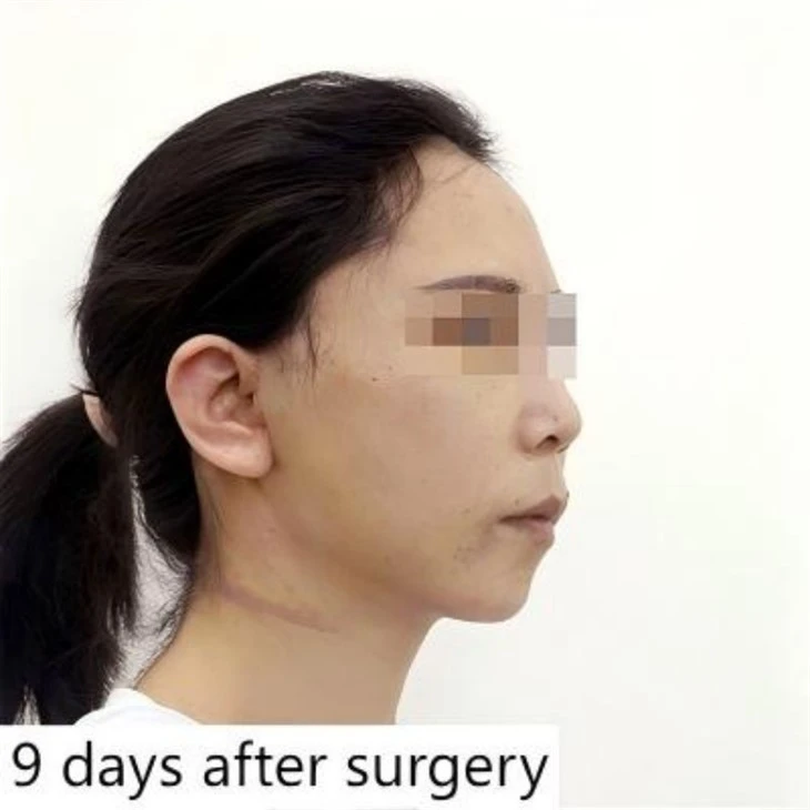 Bottom Lift Plastic Surgery